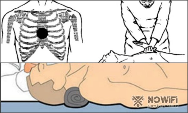 Первая помощь при остановке сердца